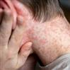 Một số câu hỏi về bệnh Sởi